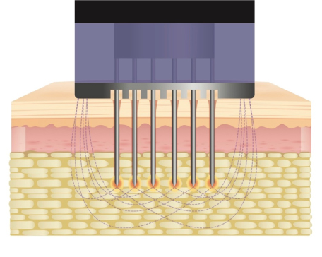 モフィウス8とは