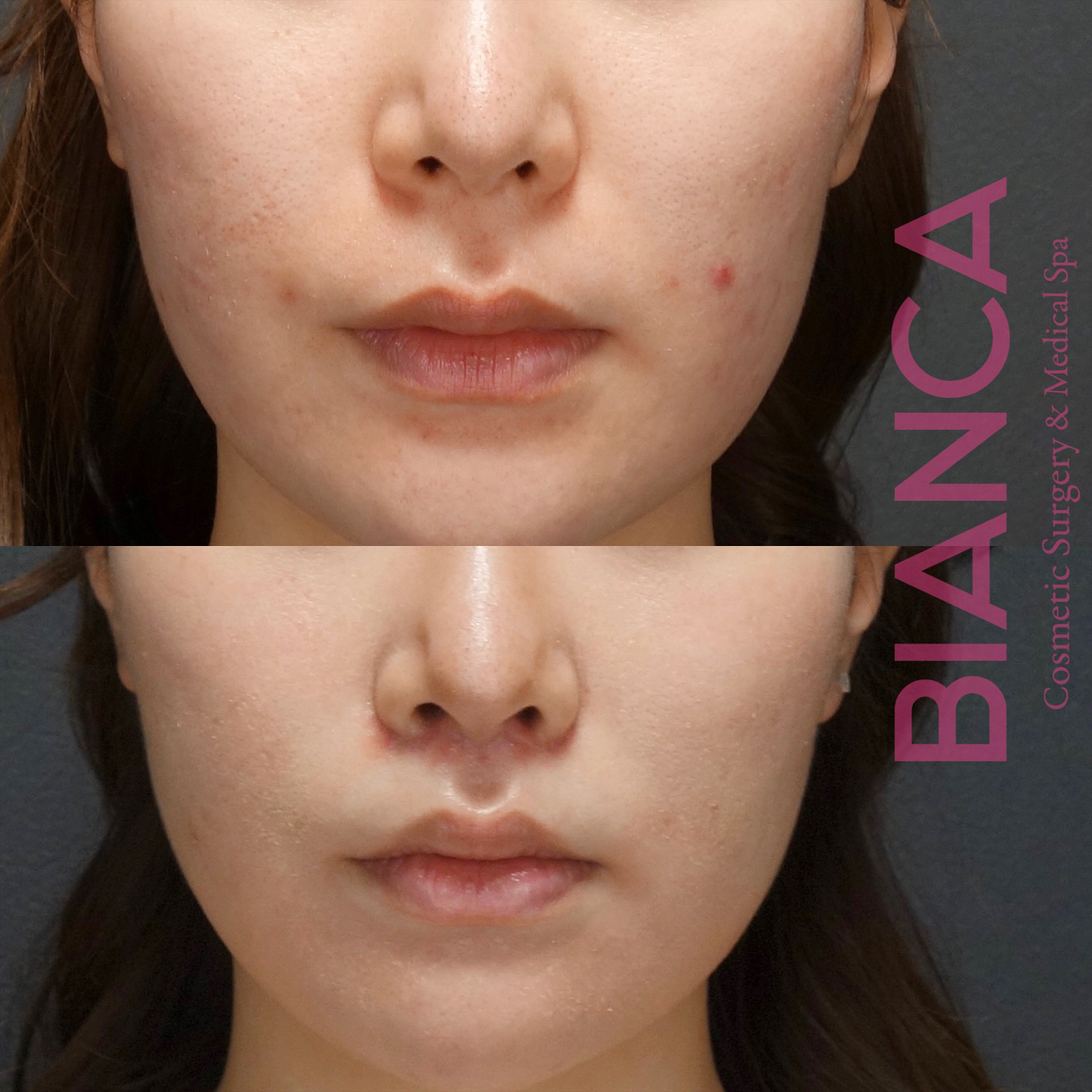 リップリフトでフェイスラインを際立たせる