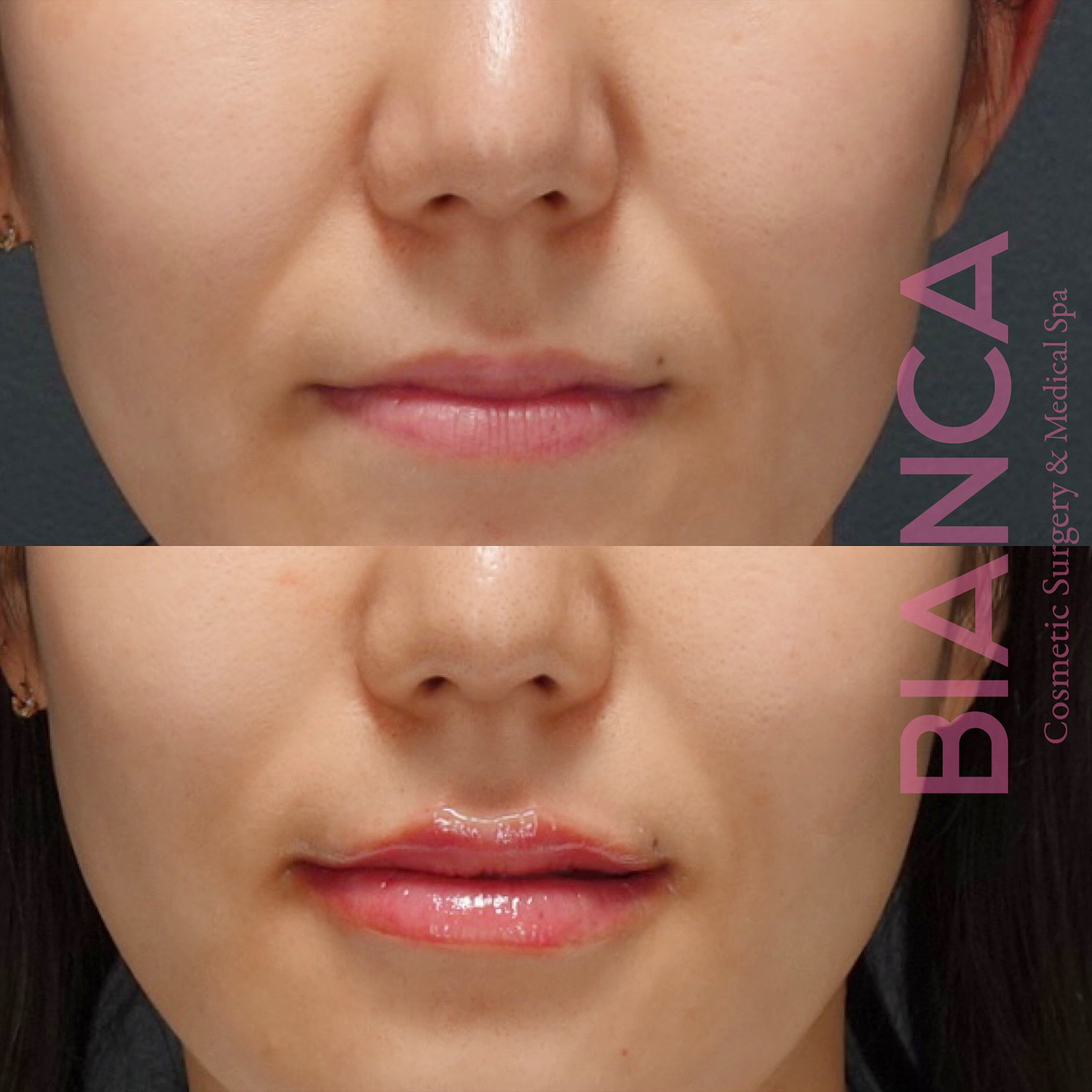 リップヒアルロン酸