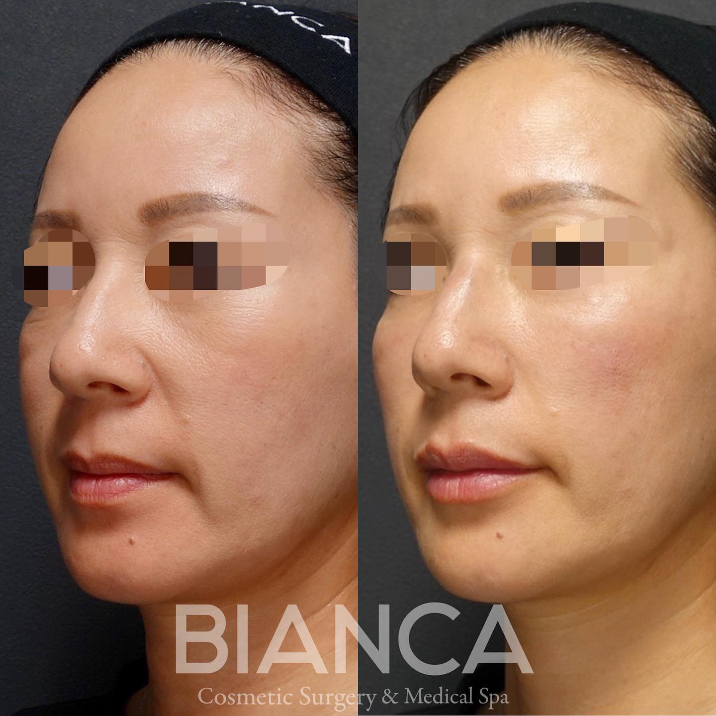 ほうれい線に注入せずに、ほうれい線を浅くする