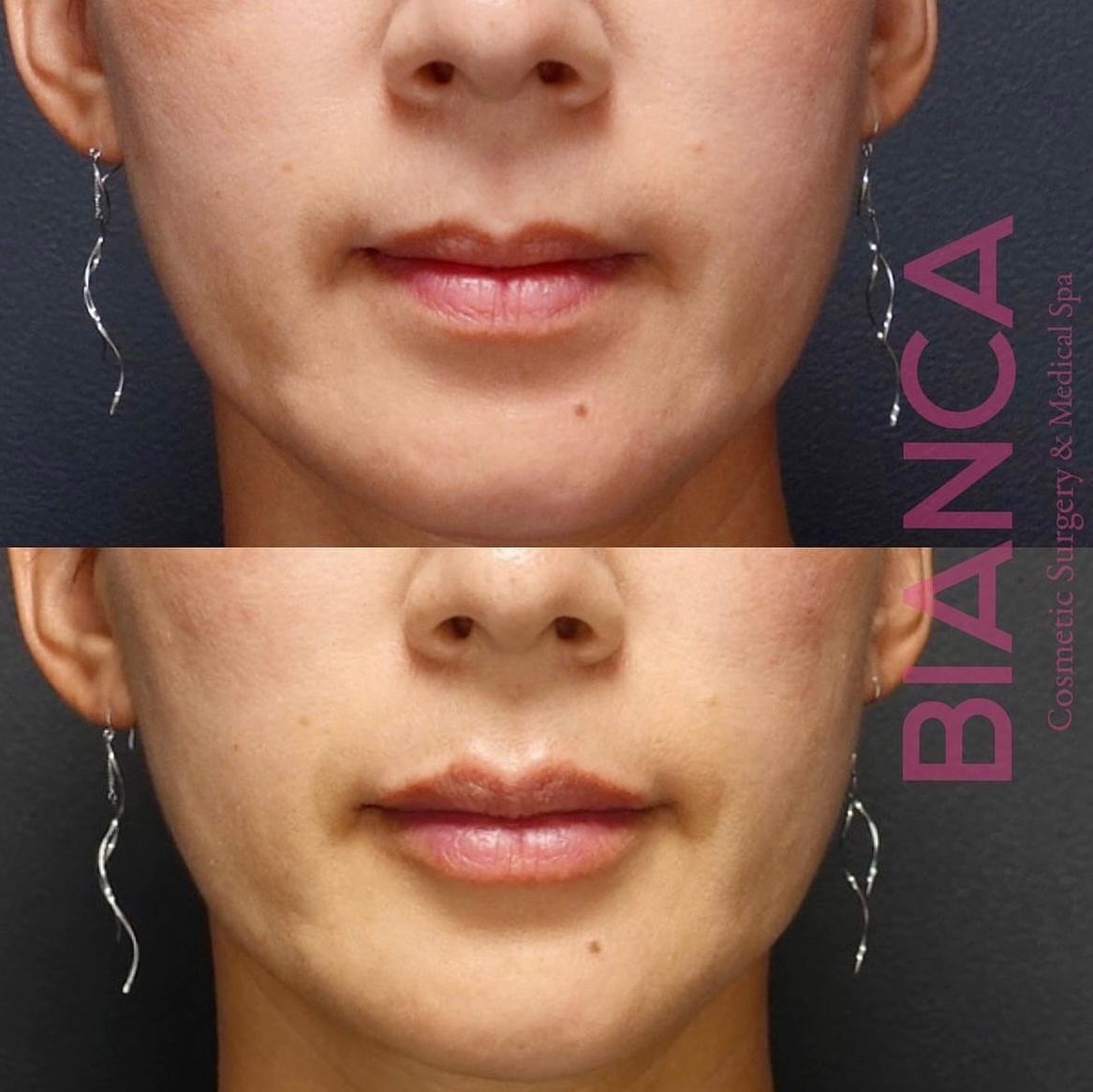 自然に口元のアンチエイジング