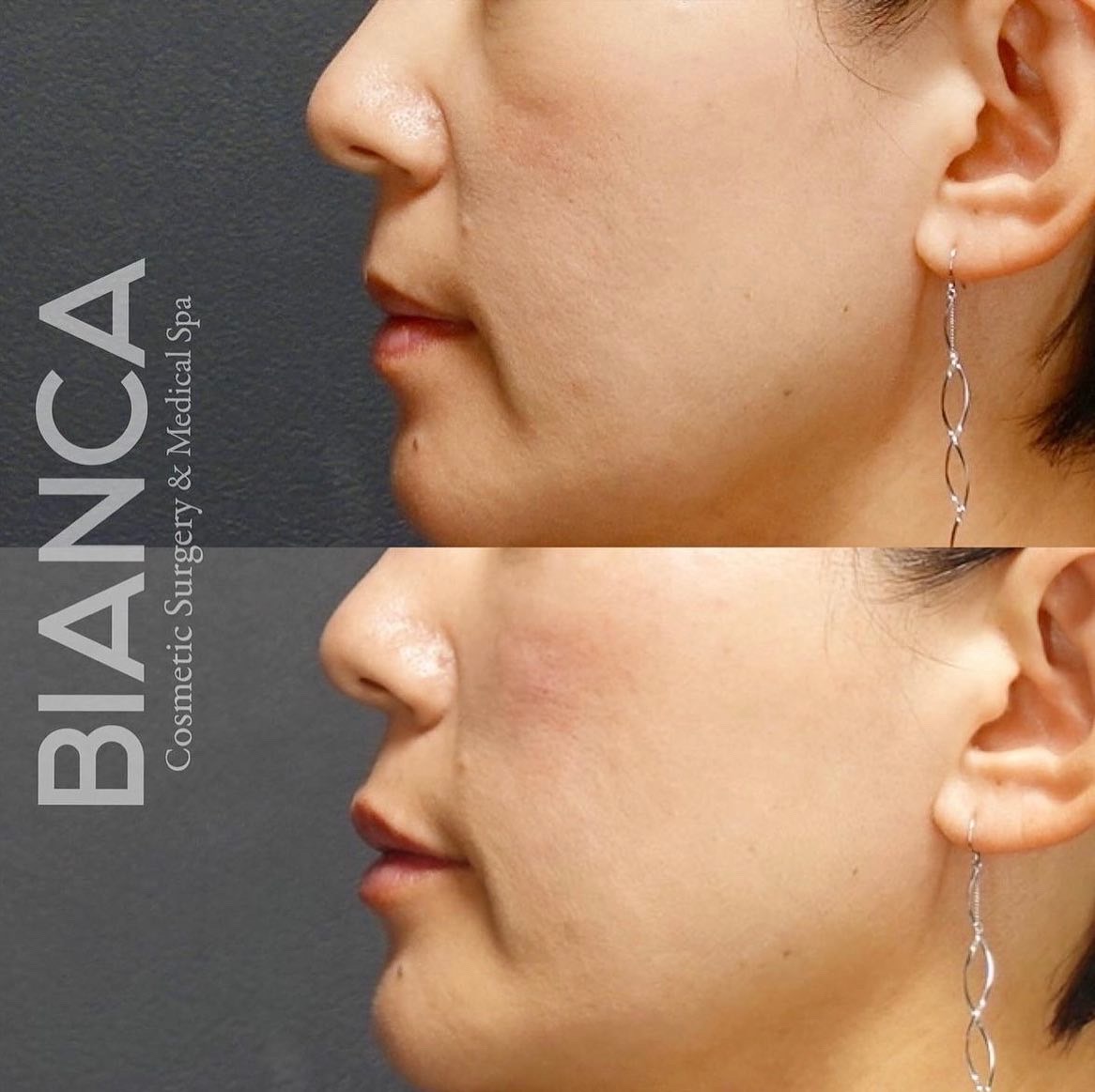 自然に口元のアンチエイジング