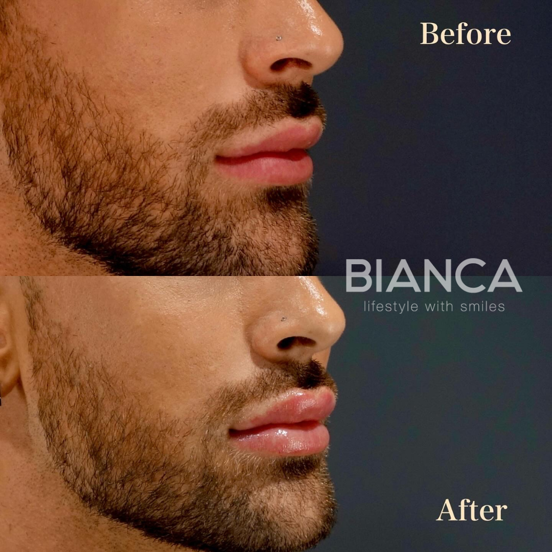 唇ヒアルロン酸