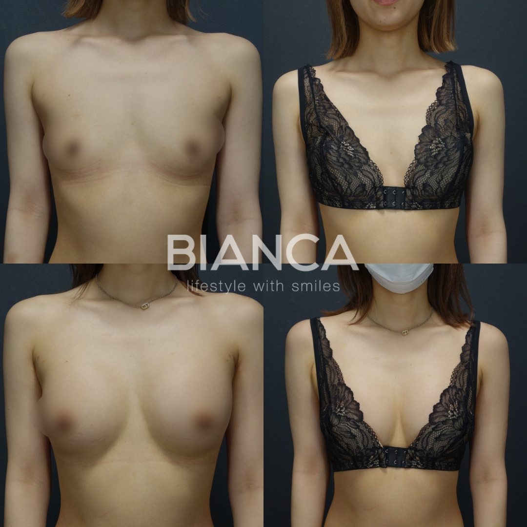 ハイブリッド豊胸　術後５カ月