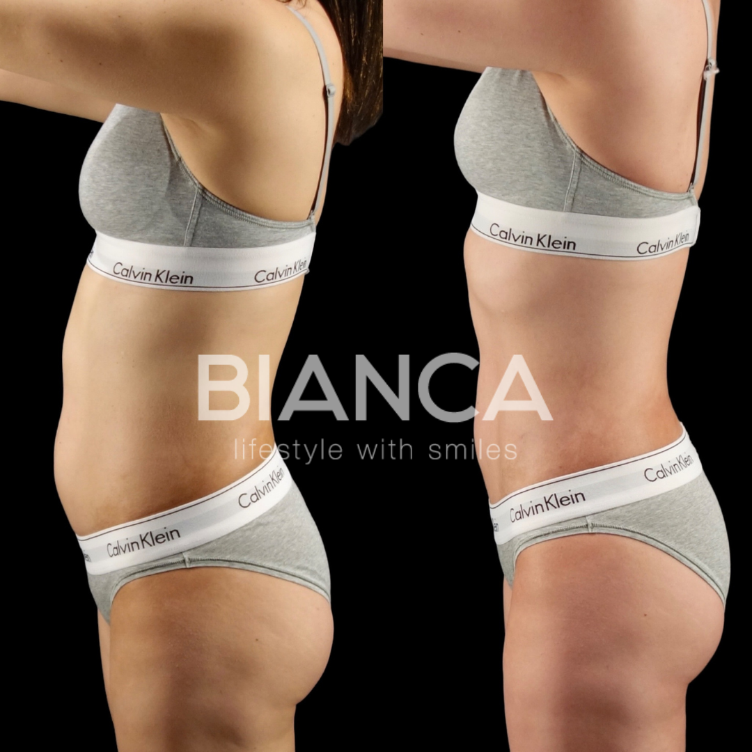 お腹の脂肪吸引　術後3ヶ月