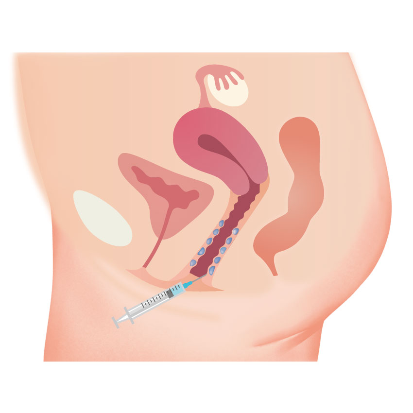 膣ヒアルロン酸注入／注射