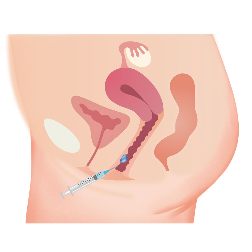 Gショット（感度アップヒアルロン酸注入）