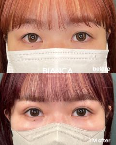 瞼が腫れぼったい！原因と治療法をタイプ別に解説！【医師監修】