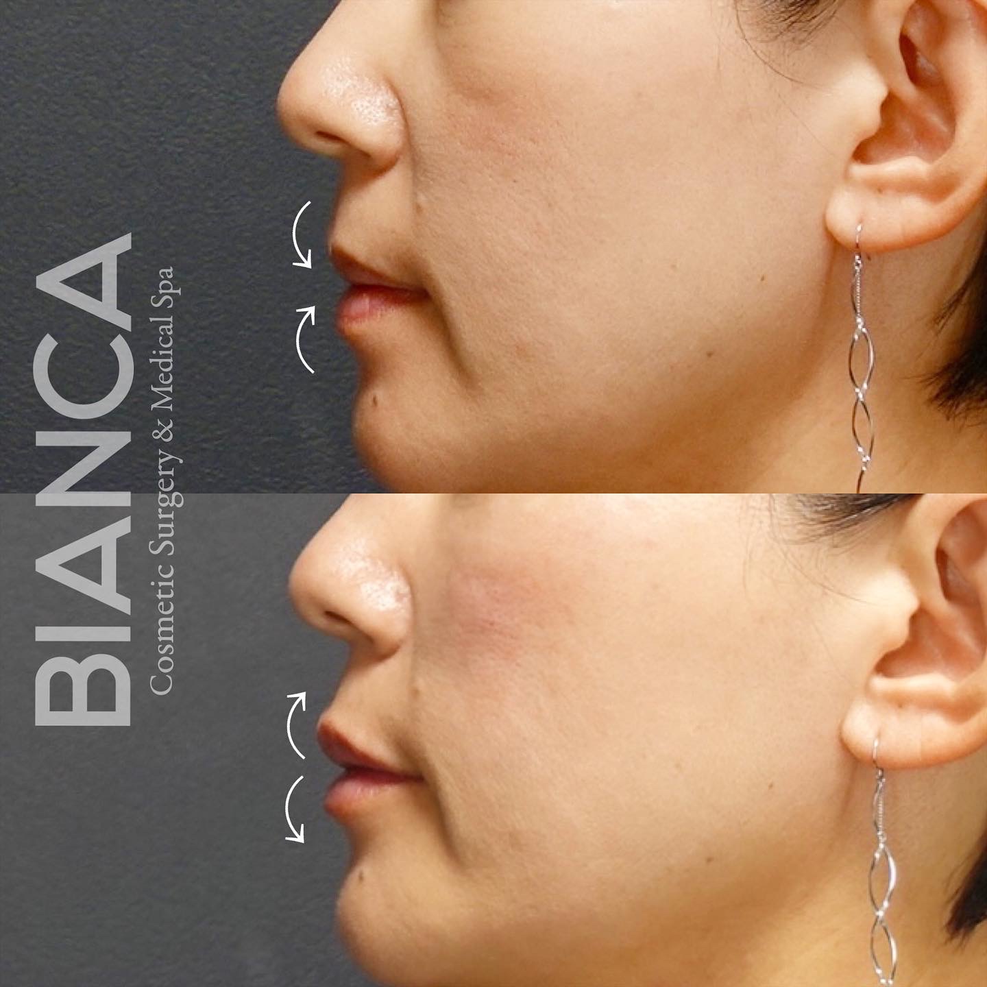 リップヒアルロン酸