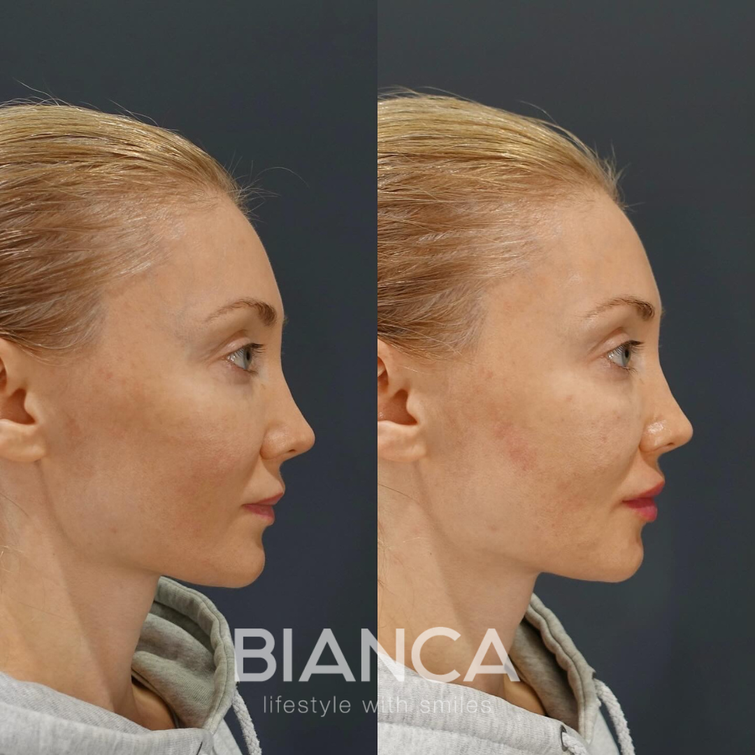 唇ヒアルロン酸