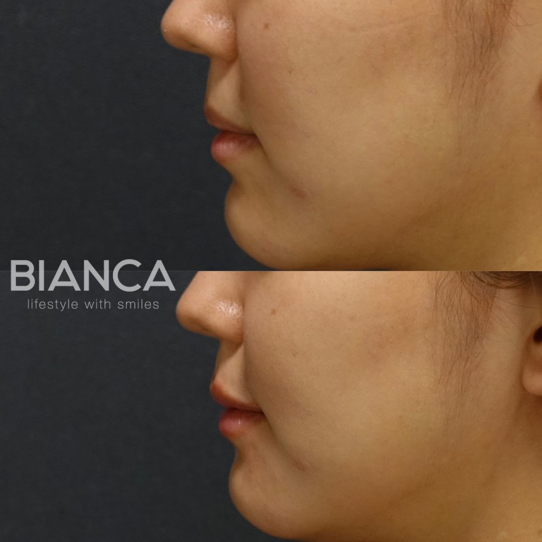 唇ヒアルで上品な変化