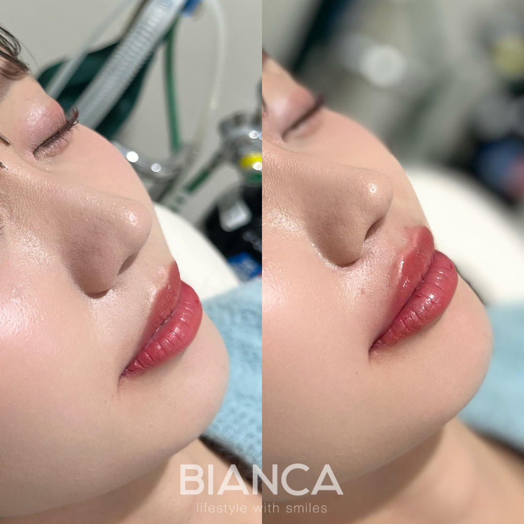 唇ヒアルロン酸でお顔全体をグッと洗練