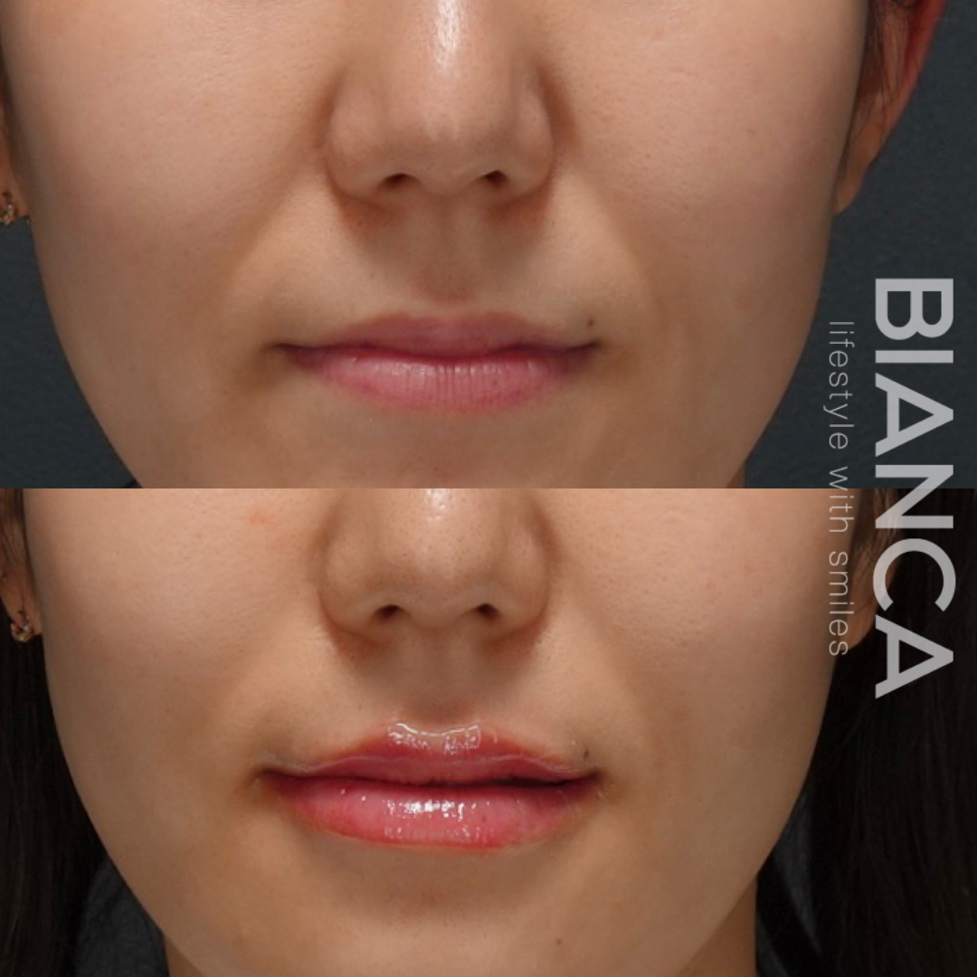 リップヒアルロン酸