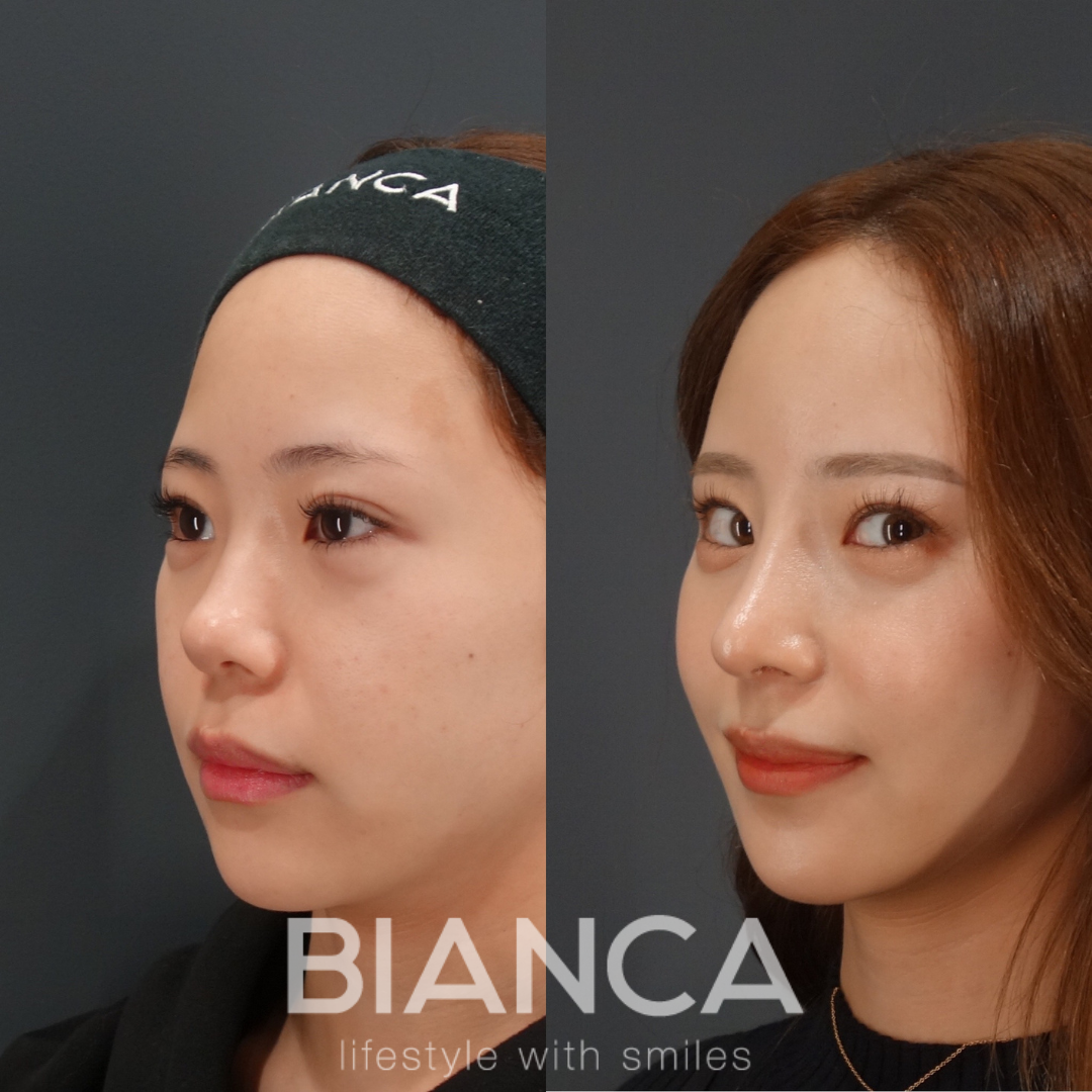 鼻中隔延長×鼻尖形成×鼻デザインプロテーゼ(特注)×額こめかみヒアルロン酸注入