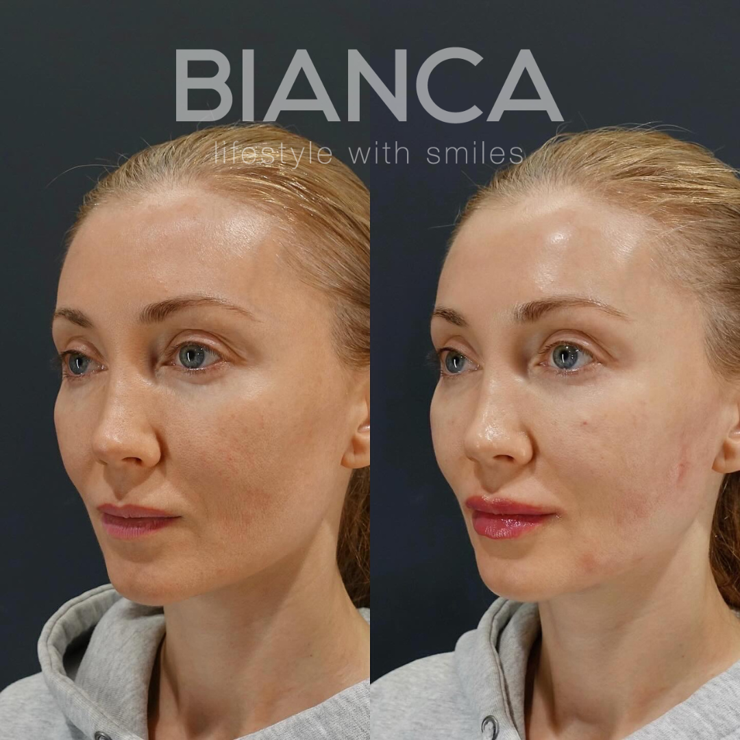 唇ヒアルロン酸