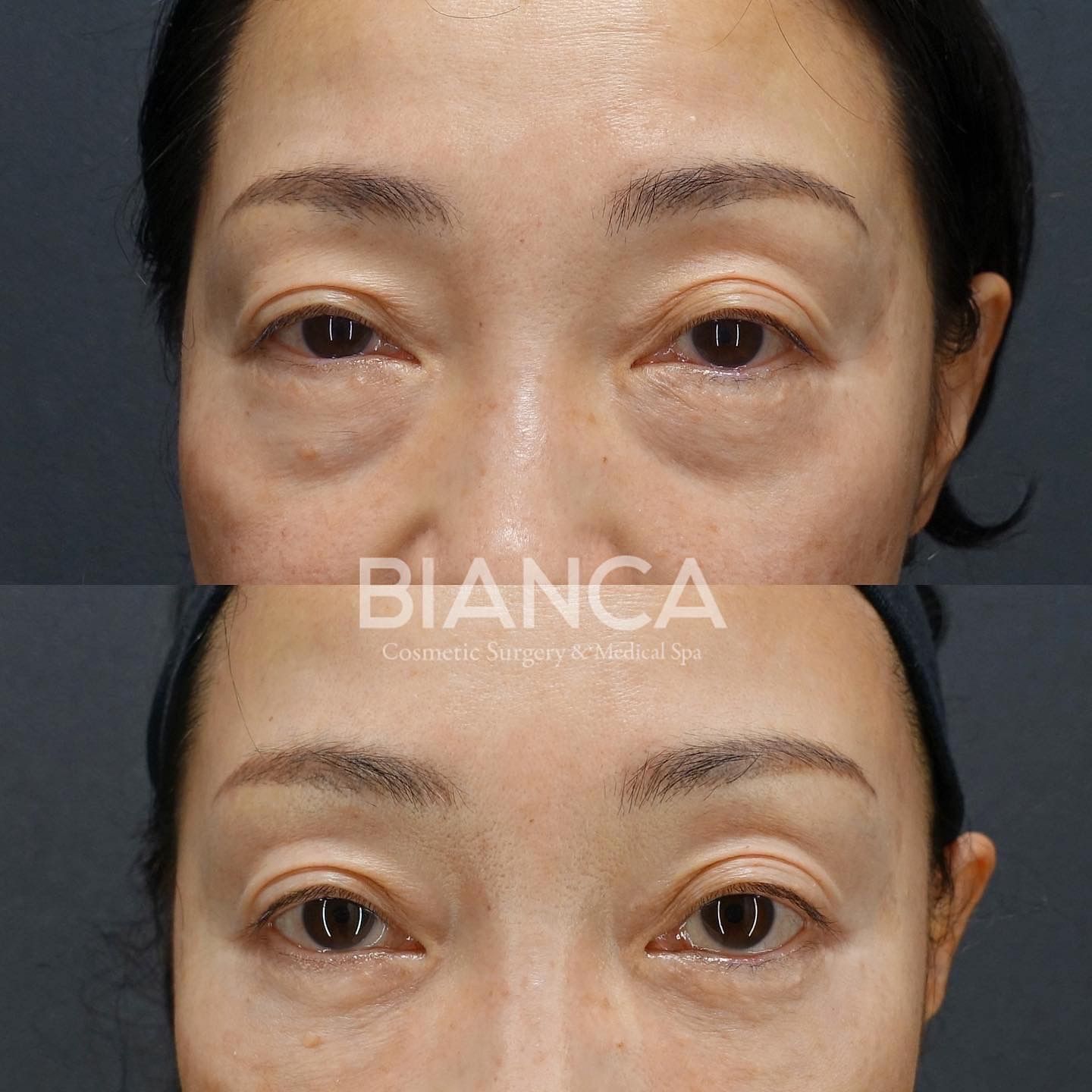 一気に若返りをしたい方は | 日本を代表する美容健康再生医療のクリニック|BIANCAGINZA