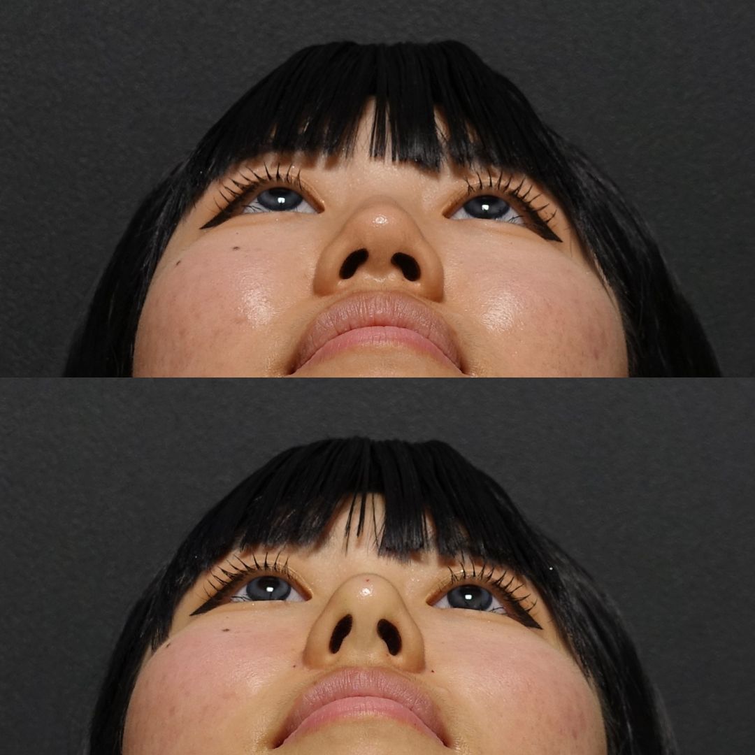 口元の突出感を改善 | 日本を代表する美容健康再生医療のクリニック｜BIANCAGINZA