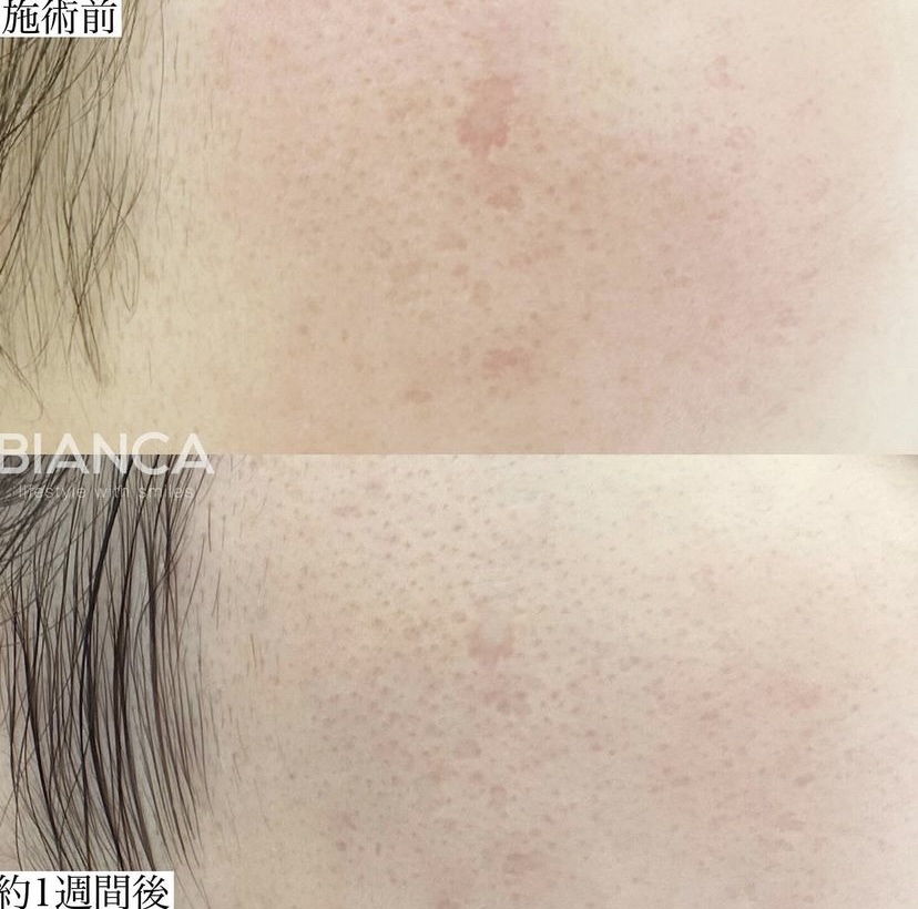 トライフィルプロをやってみた