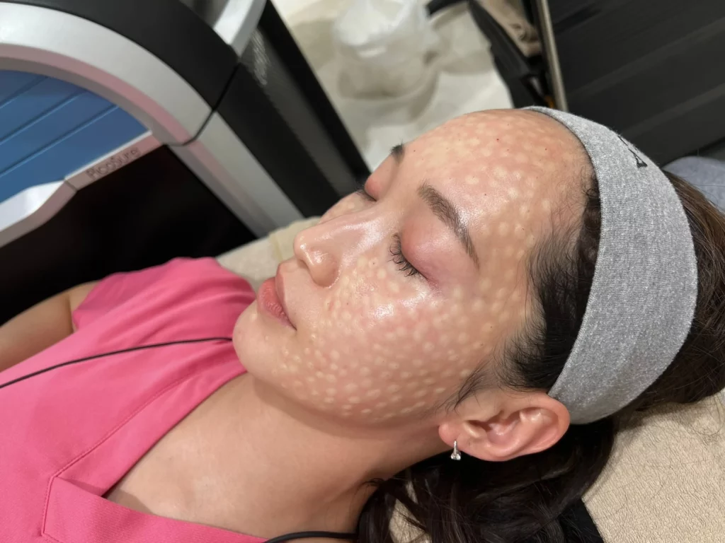 ハイドロブーストの効果とは？肌のハリ・うるおい・ツヤを引き出すスキンブースター【ビアンカクリニック】