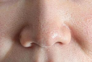 毛穴の開きにはジュベルック！ビアンカドクターが解説