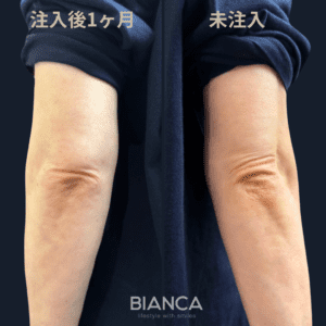 ボディヒアル（肘ヒアルロン酸）