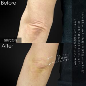 ボディヒアル（肘ヒアルロン酸）の症例