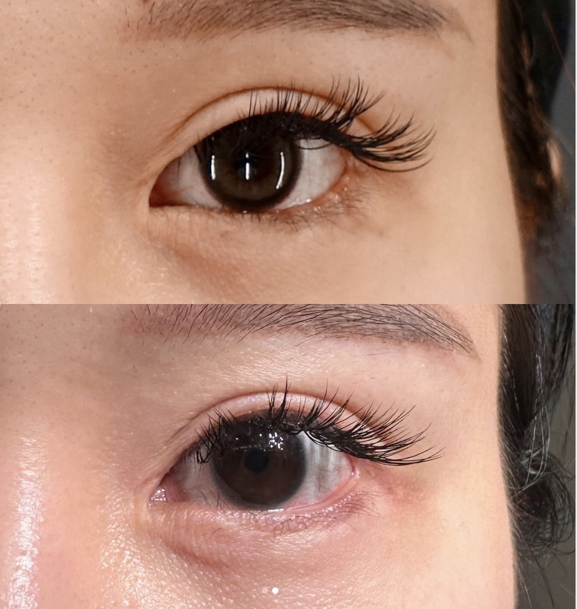 睫毛上皮膚切除（ハム目修正）