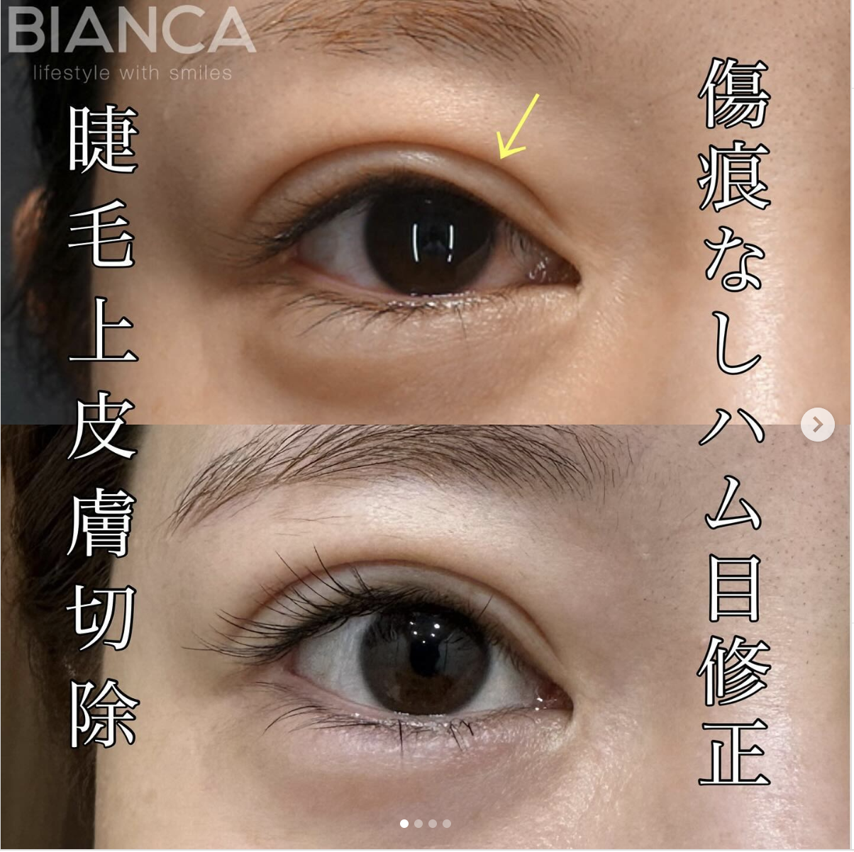 睫毛上皮膚切除（ハム目修正）