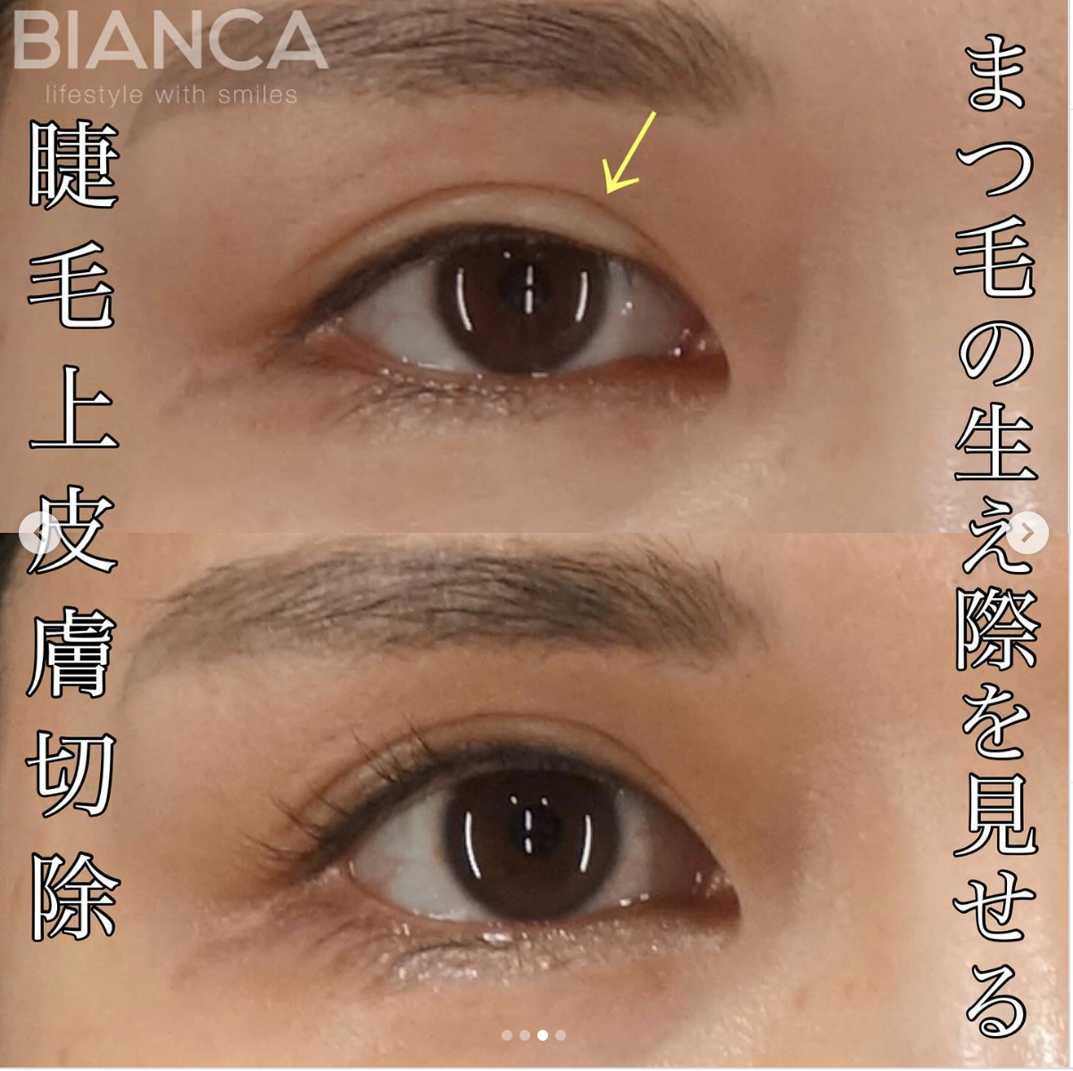 睫毛上皮膚切除（ハム目修正）