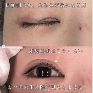睫毛上皮膚切除（ハム目修正）メニューページ症例5