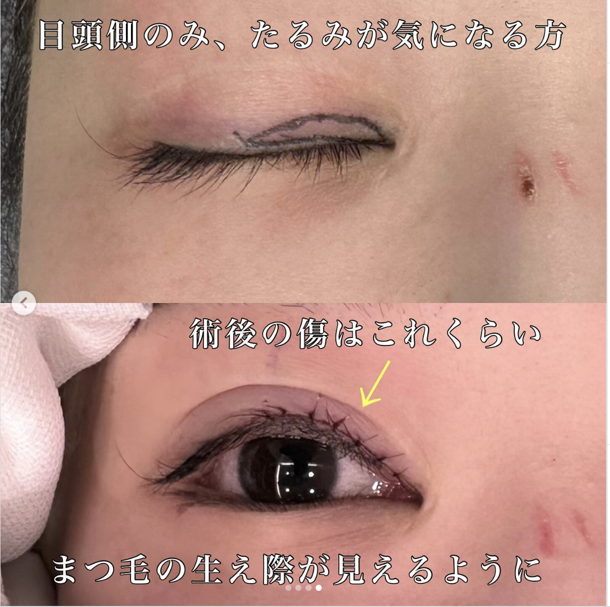 睫毛上皮膚切除（ハム目修正）