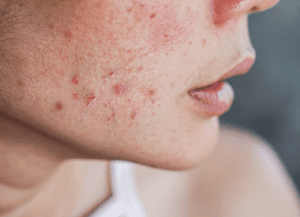 イソトレチノイン治療を始める前のニキビ（イメージ）