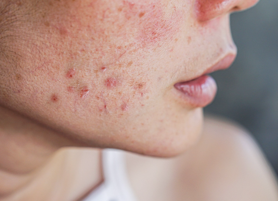 イソトレチノインの効果って？ニキビ再発を防ぐポイントをビアンカクリニック明石仙姫医師が解説