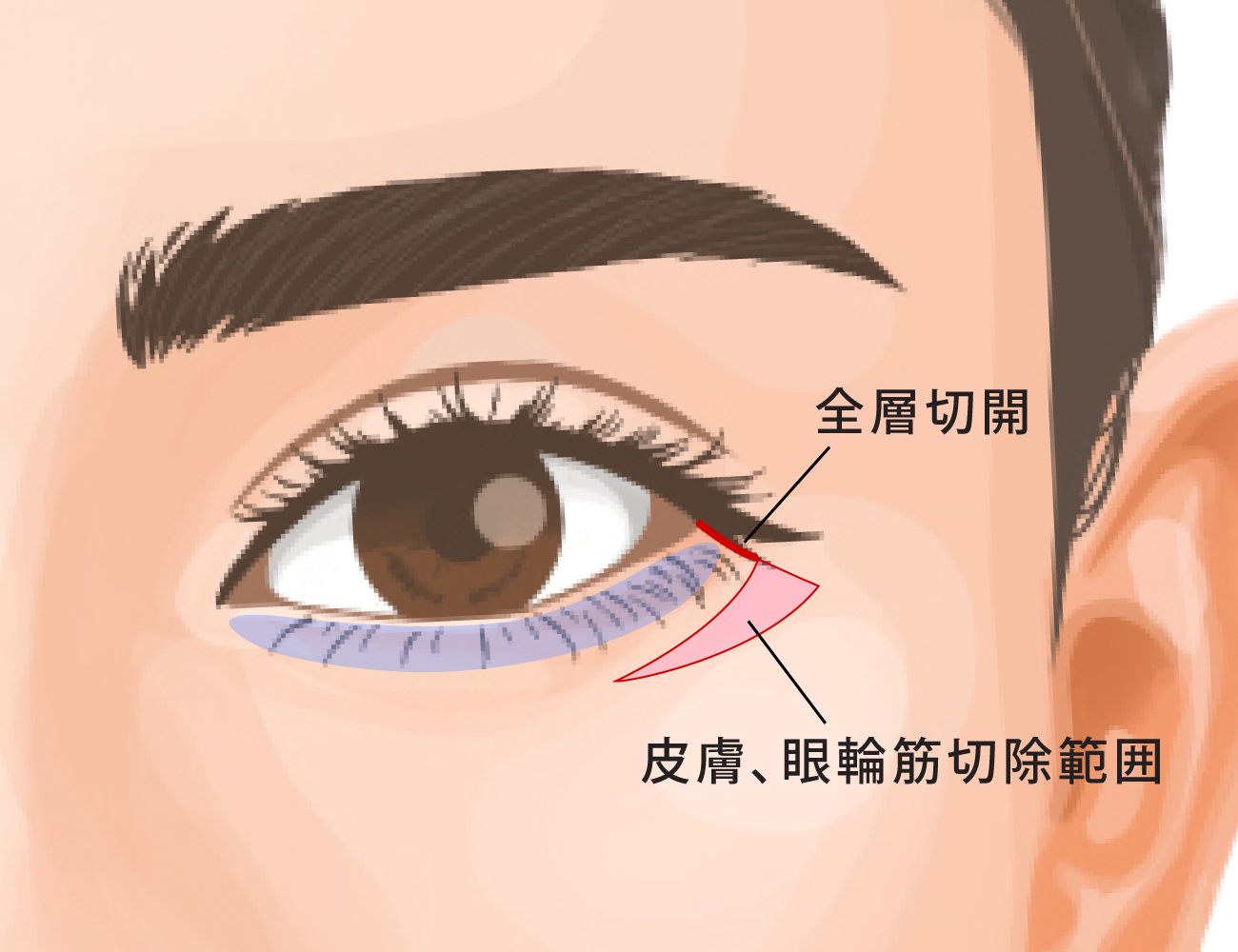 タレ目尻切開（タレ目形成）