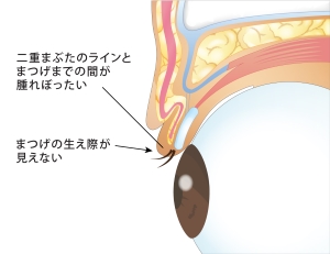 睫毛上皮膚切除（ハム目修正）とは