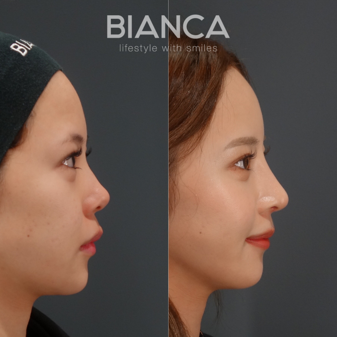 垢抜け美人、鼻整形