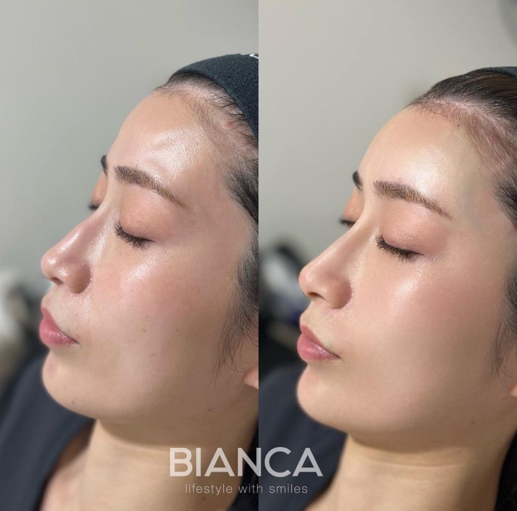 鷲鼻はヒアルロン酸の良い適応