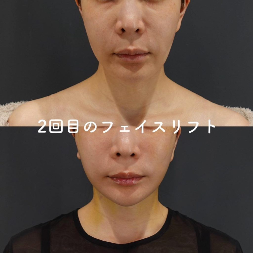 フェイスリフトの再手術は何回までできる？形成外科医が解説