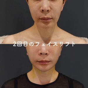 フェイスリフトの再手術は何回までできる？形成外科医が解説
