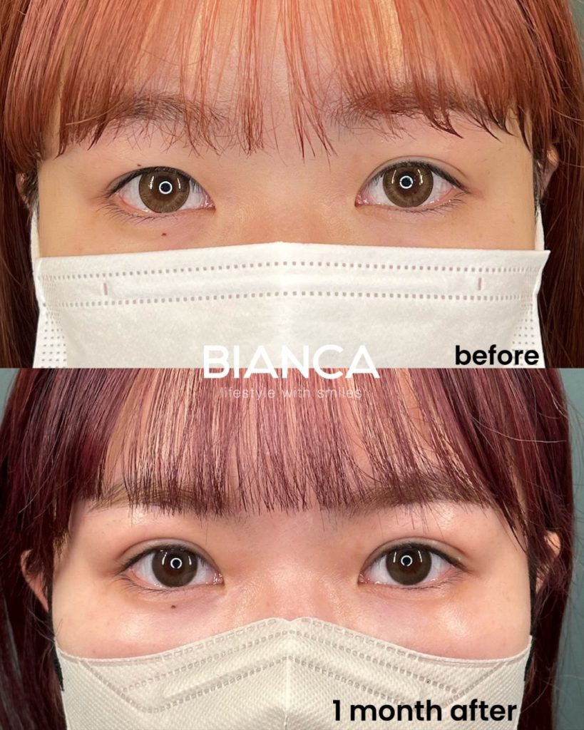 目の左右差のある人、これだけはやらないで！