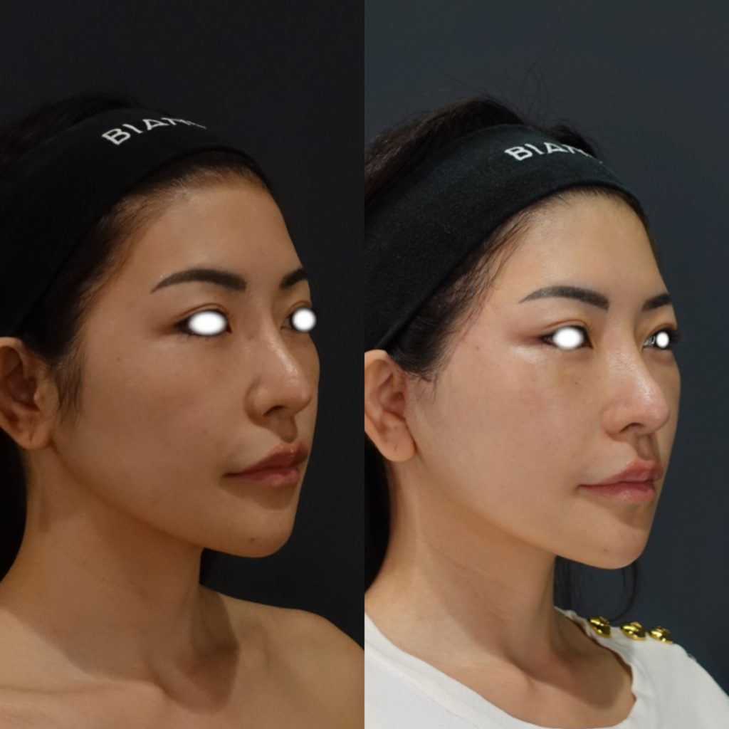 輪郭骨切り後のフェイスリフト