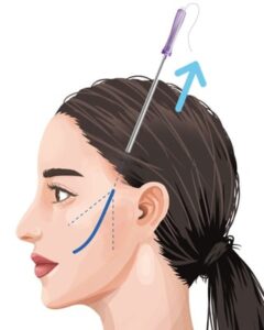 糸リフトイメージ-ビアンカクリニック