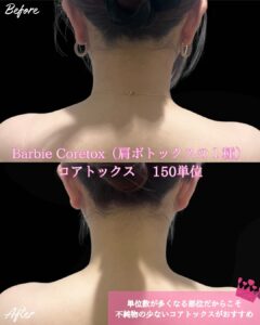 バービーボトックス症例