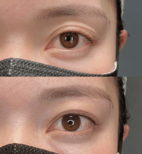 二重埋没の症例写真