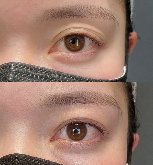 二重埋没ダウンタイムを徹底解説｜裏留め・表留め・自然癒着法なにが違う？