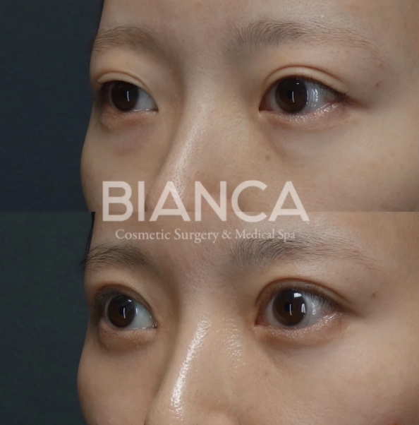 二重整形は全切開か埋没か。正直どっちが良いの？！