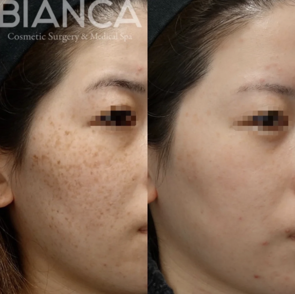 肝斑治療は保険適用になる？ビアンカクリニック明石仙姫医師が解説