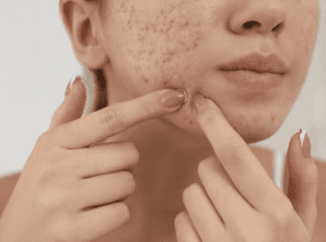 ニキビを皮膚科でどう治す？外用薬・内服・栄養サポートで整える大人の肌【医師監修】