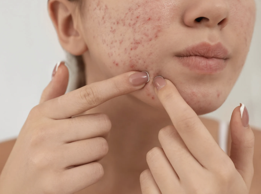 大人ニキビの原因と対策。保険適応の処方薬を中心に。