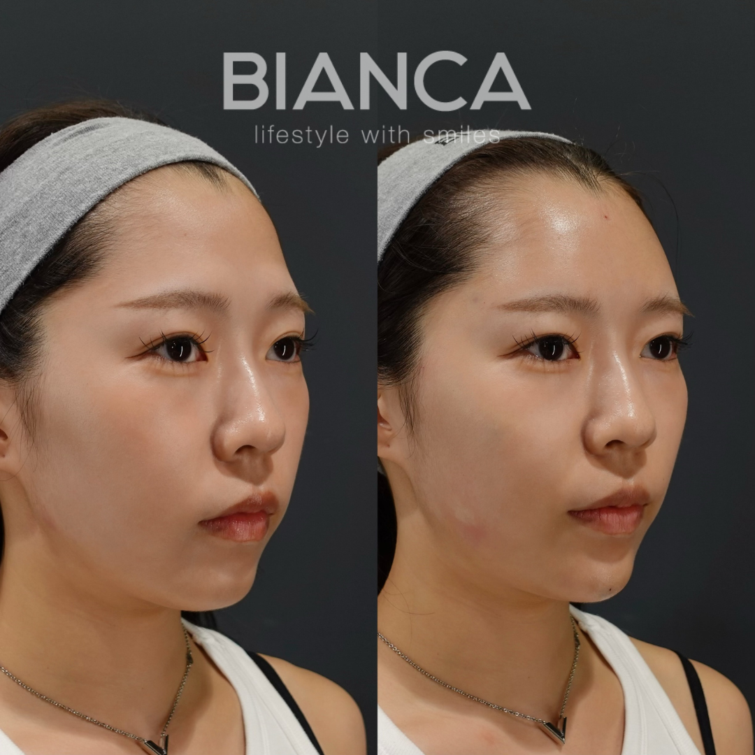 ヒアルで魅力UP【20代女性】 | 日本を代表する美容健康再生医療のクリニック｜BIANCAGINZA